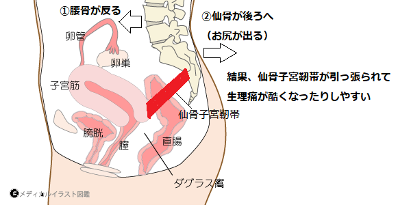 反り腰と生理痛 腰痛専門 武蔵小杉 新丸子の整体 神奈川カイロプラクティック整体院